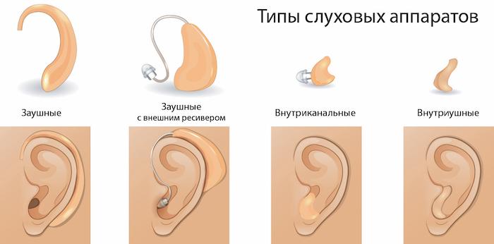Как правильно выбрать слуховой аппарат